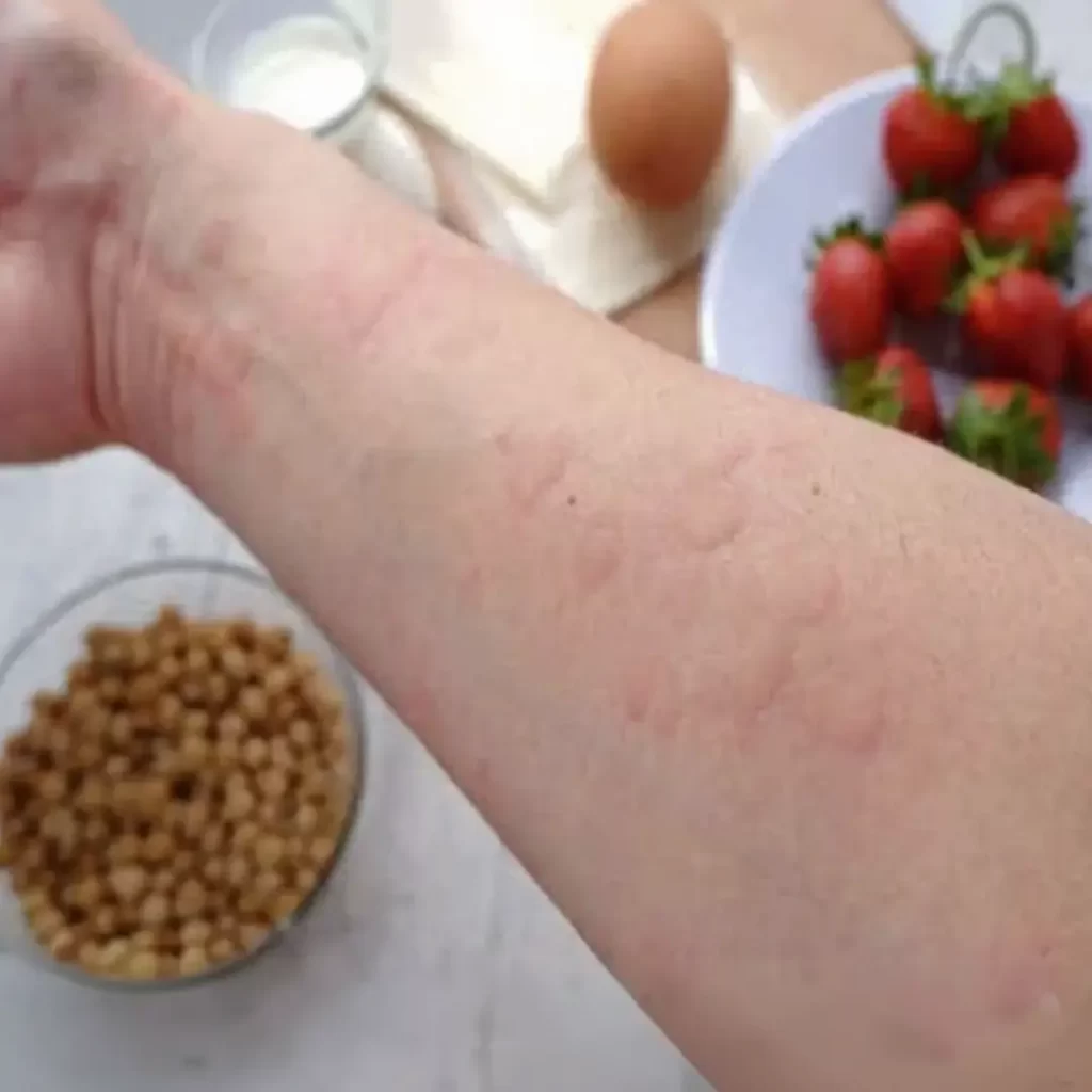 Alergias Alimentares